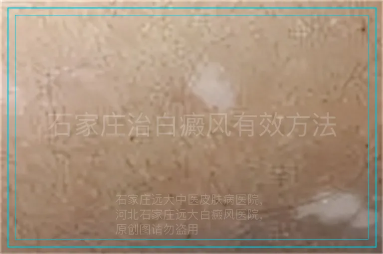 石家庄治白癜风有效方法