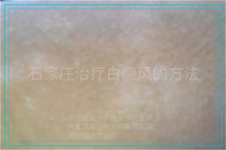 石家庄治疗白癜风的方法