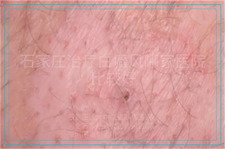 石家庄治疗白癜风哪家医院比较好