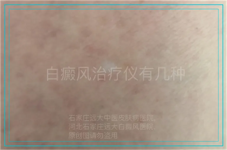 白癜风治疗仪有几种