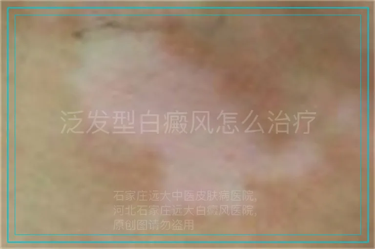泛发型白癜风怎么治疗