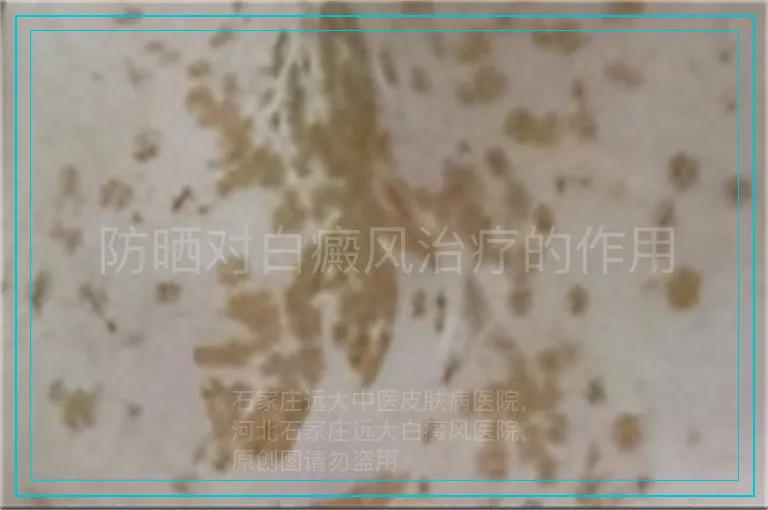防晒对白癜风治疗的作用
