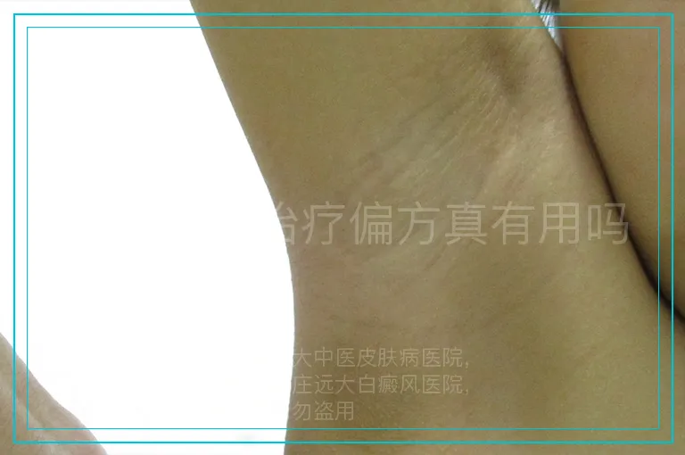 白癜风的治疗偏方真有用吗