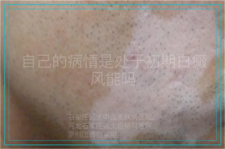 自己的病情是处于初期白癜风能吗