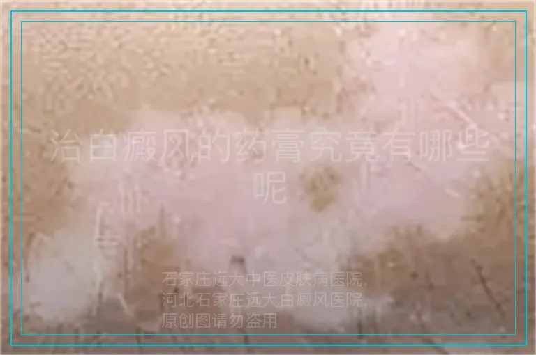 治白癜风的药膏究竟有哪些呢