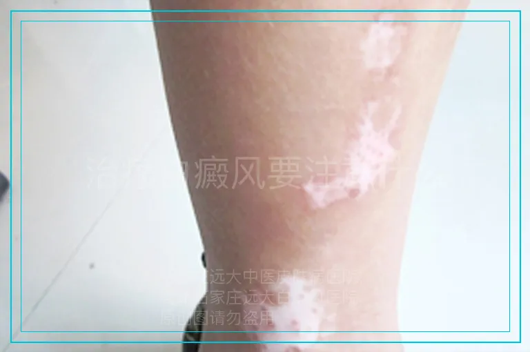 治疗白癜风要注意什么