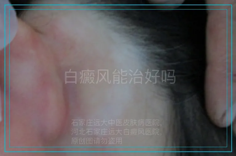 白癜风能治好吗