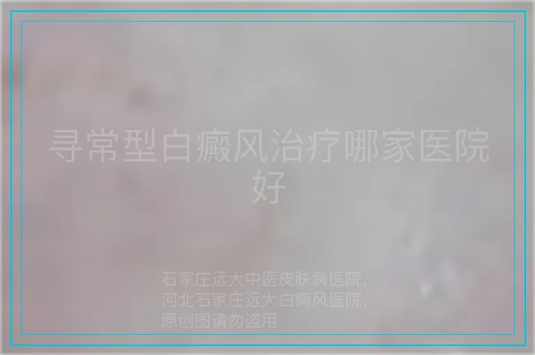 寻常型白癜风治疗哪家医院好