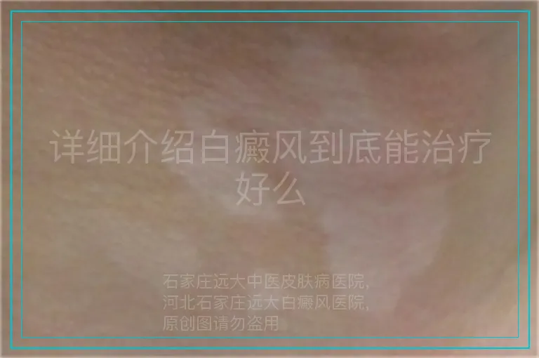 详细介绍白癜风到底能治疗好么