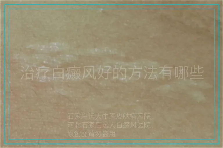 治疗白癜风好的方法有哪些