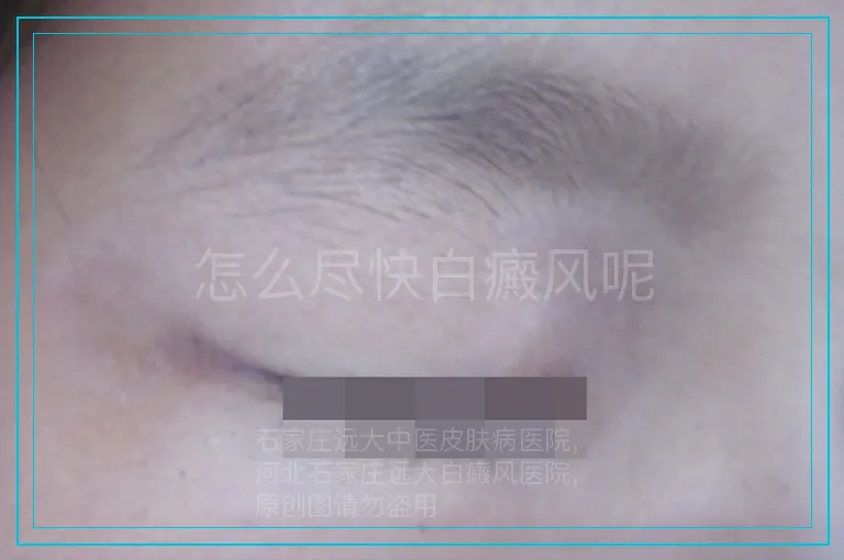 怎么尽快白癜风呢