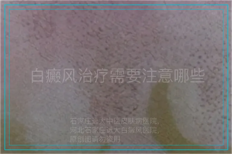 白癜风治疗需要注意哪些