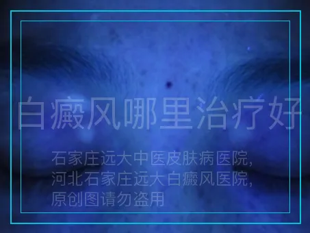 白癜风哪里治疗好