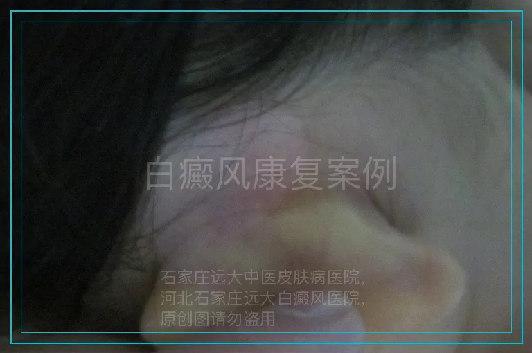 白癜风康复案例