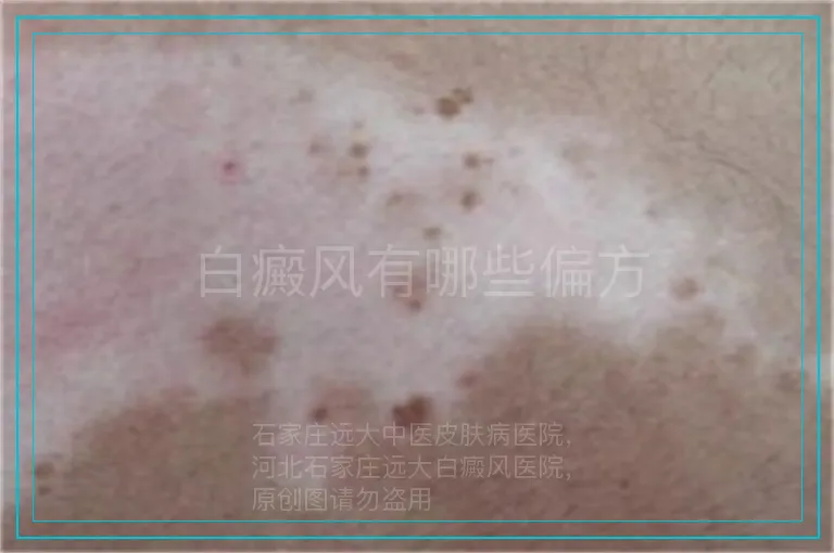 白癜风有哪些偏方