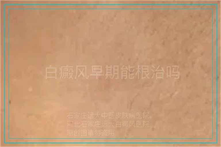白癜风早期能根治吗