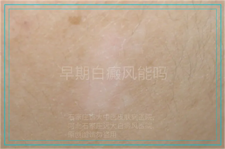 早期白癜风能吗
