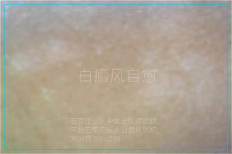 白癜风自愈