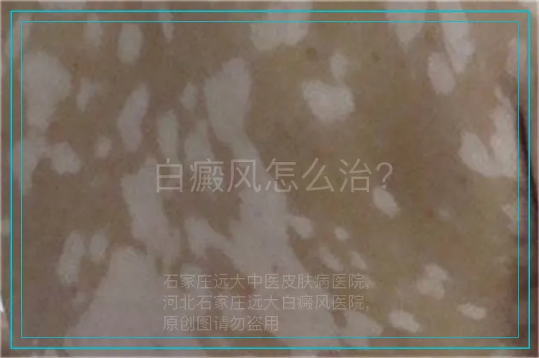 白癜风怎么治?