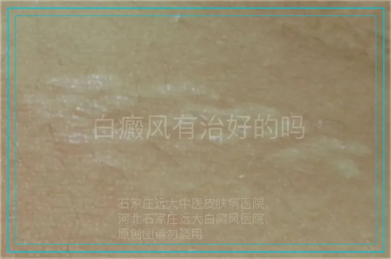 白癜风有治好的吗