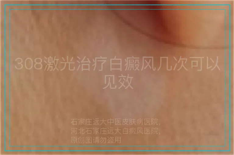 308激光治疗白癜风几次可以见效