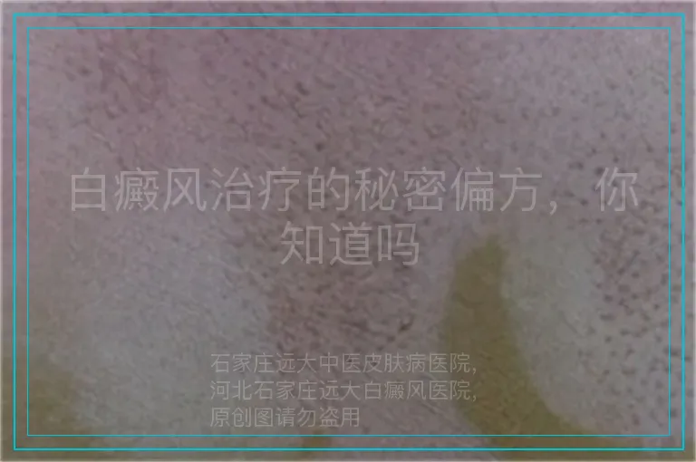 白癜风治疗的秘密偏方,你知道吗