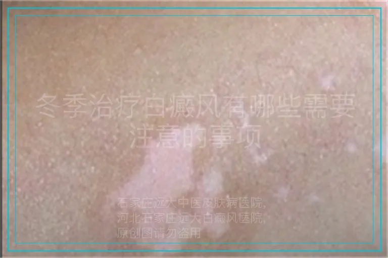 冬季治疗白癜风有哪些需要注意的事项