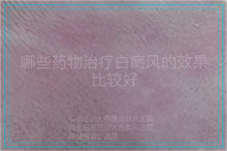 哪些药物治疗白癜风的效果比较好
