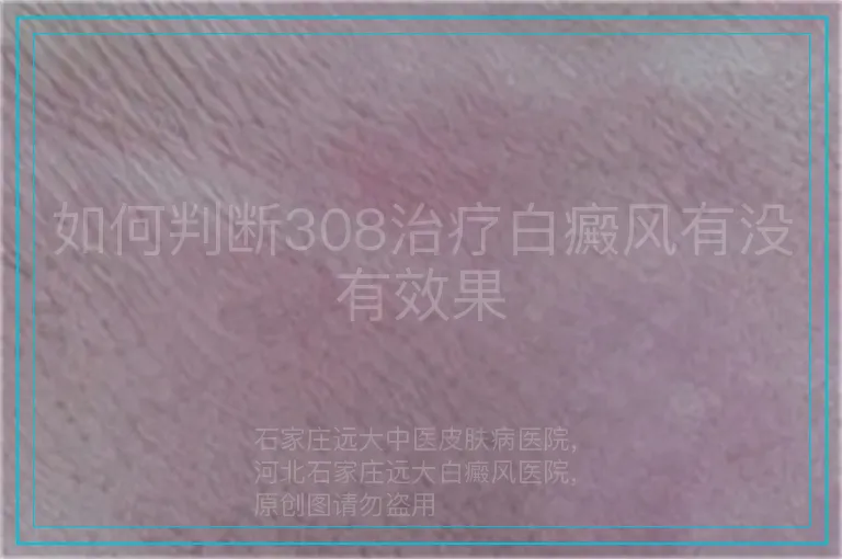 如何判断308治疗白癜风有没有效果