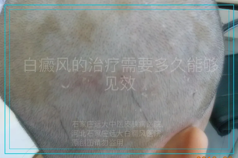 白癜风的治疗需要多久能够见效