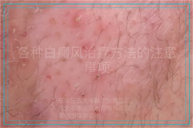 各种白癜风治疗方法的注意事项