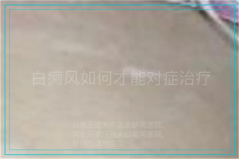 白癜风如何才能对症治疗
