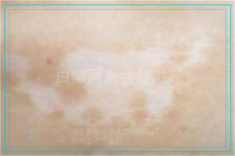 白癜风后会复发吗