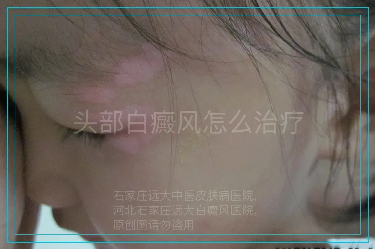 头部白癜风怎么治疗