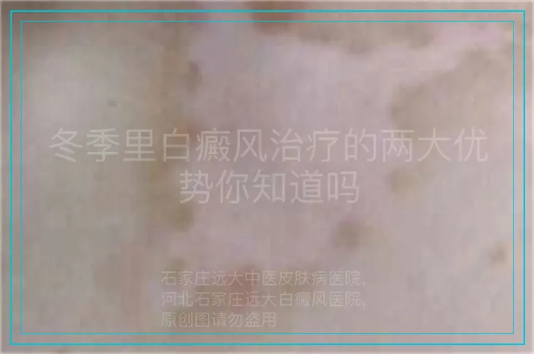 冬季里白癜风治疗的两大优势你知道吗