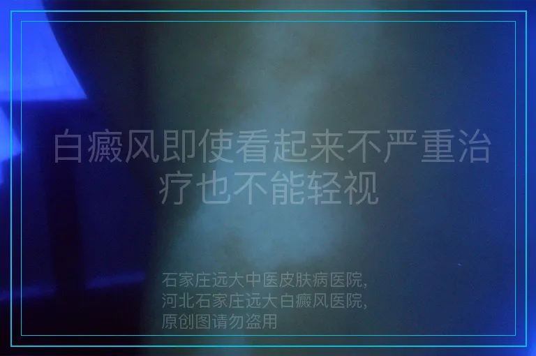 白癜风即使看起来不严重治疗也不能轻视