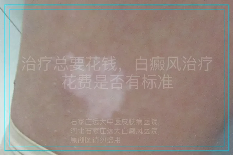 治疗总要花钱,白癜风治疗花费是否有标准