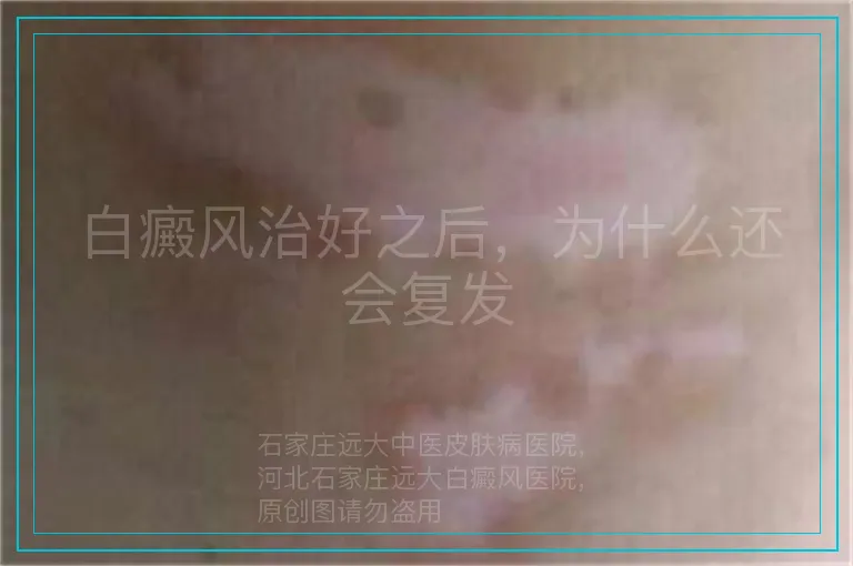 白癜风治好之后，为什么还会复发