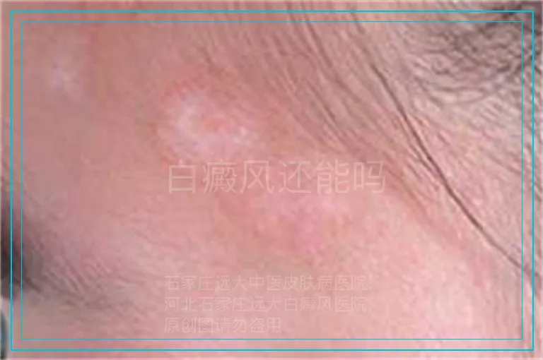 白癜风还能吗