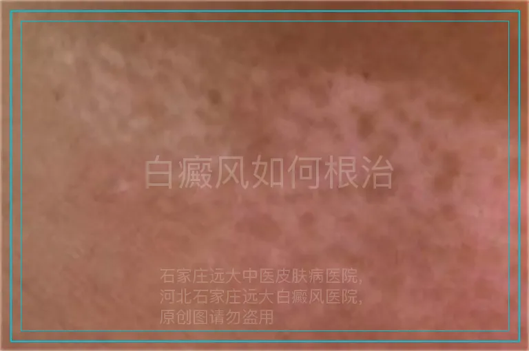 白癜风如何根治