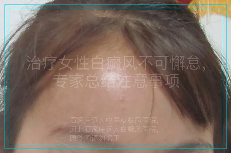 治疗女性白癜风不可懈怠，专家总结注意事项