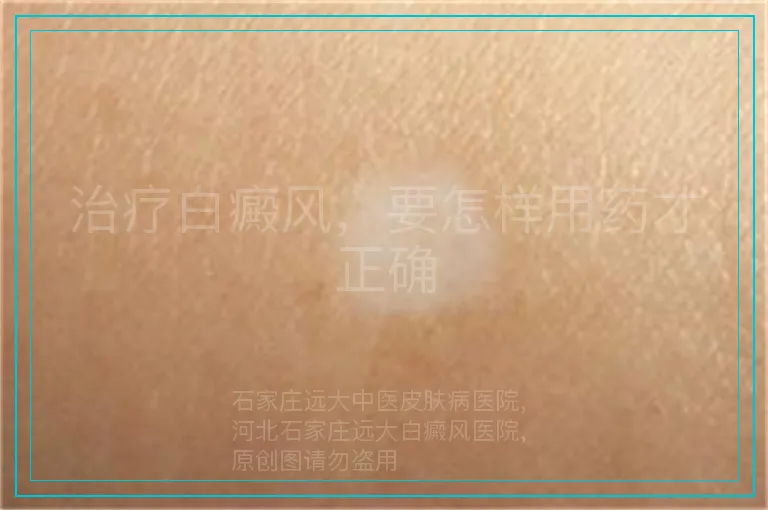 治疗白癜风,要怎样用药才正确