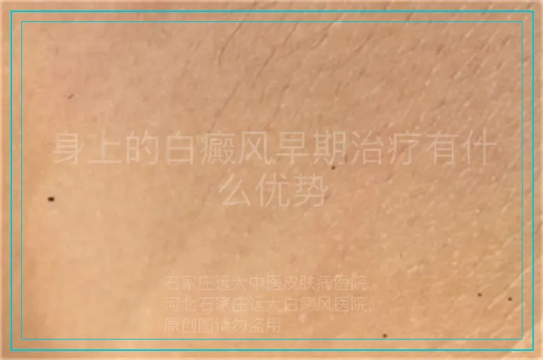 身上的白癜风早期治疗有什么优势
