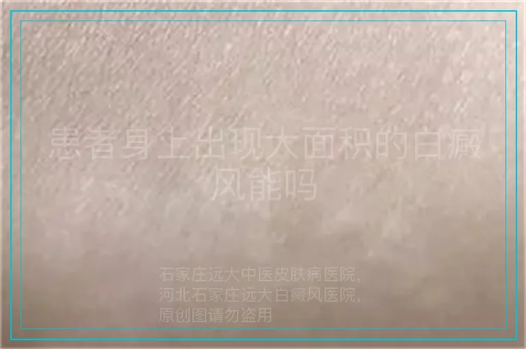 患者身上出现大面积的白癜风能吗