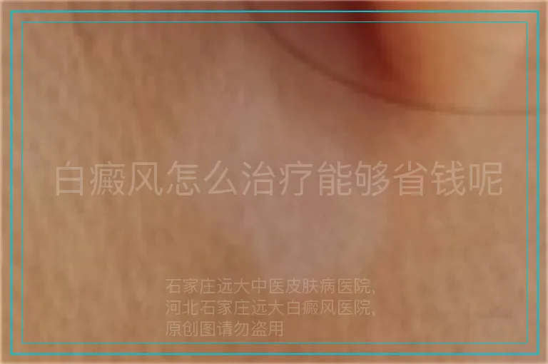 白癜风怎么治疗能够省钱呢