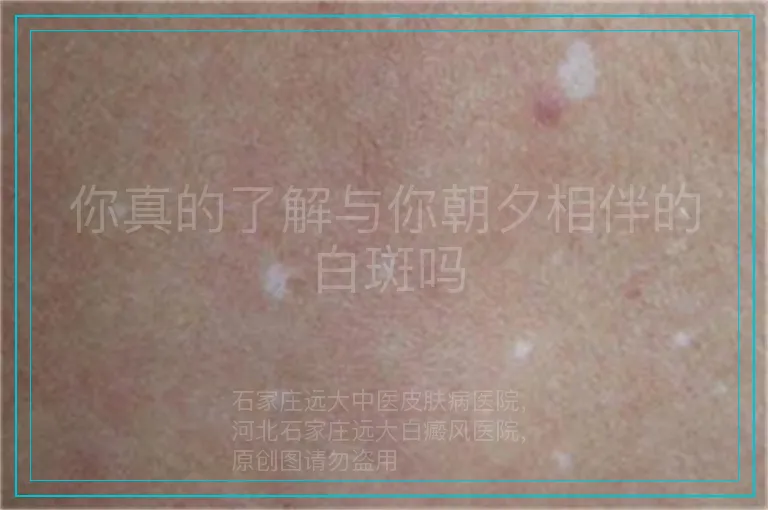 你真的了解与你朝夕相伴的白斑吗