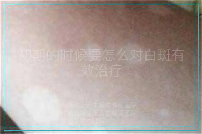 初期的时候要怎么对白斑有效治疗