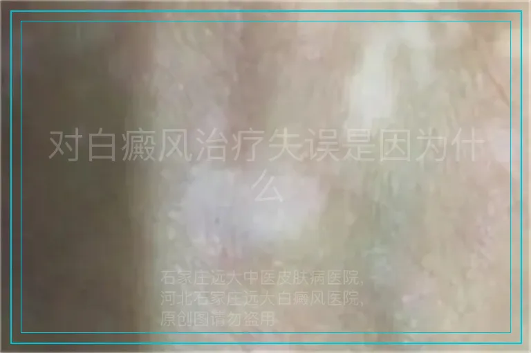 对白癜风治疗失误是因为什么