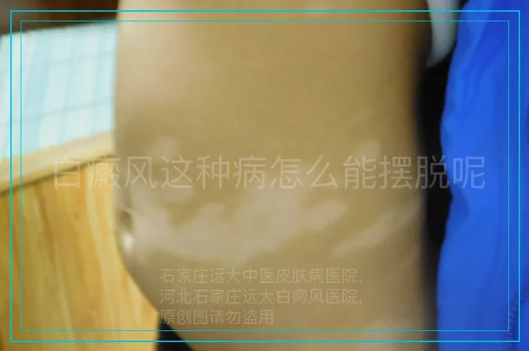 白癜风这种病怎么能摆脱呢