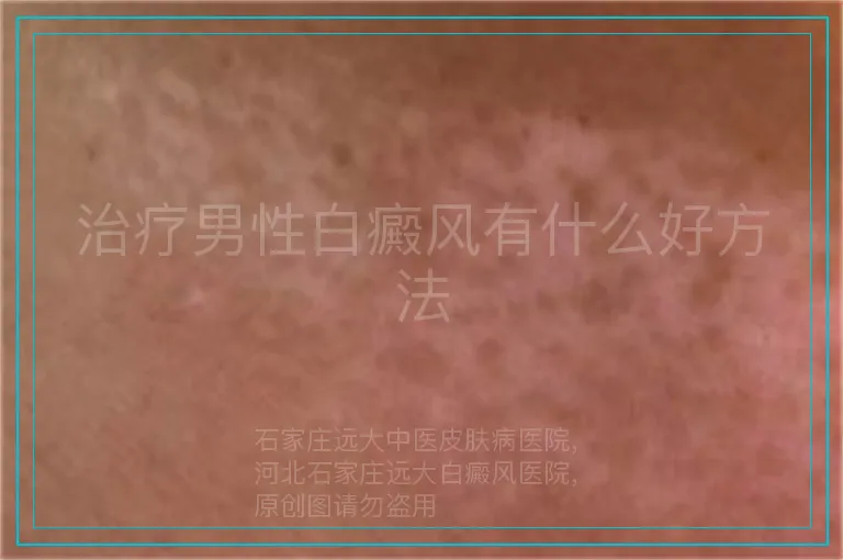 治疗男性白癜风有什么好方法